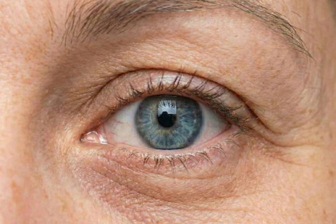 Como são os primeiros dias após a Blefaroplastia?